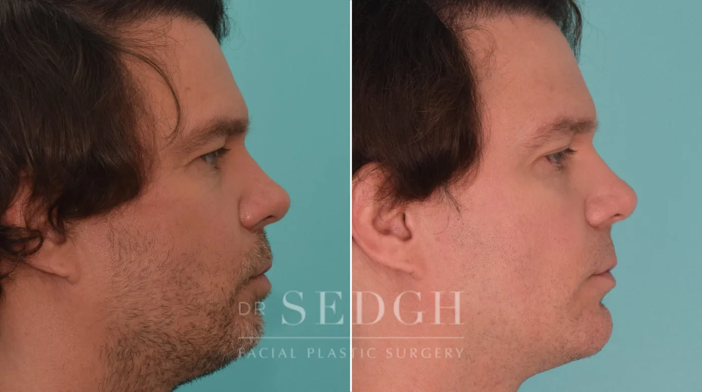 Patient 188 after Chin Augmentation, view 2