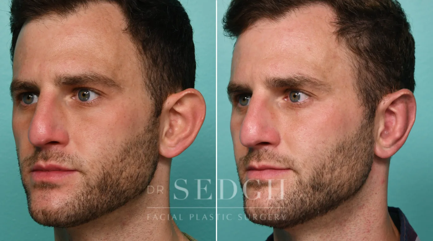 Patient 320 before Ear Pinning Surgery, view 2