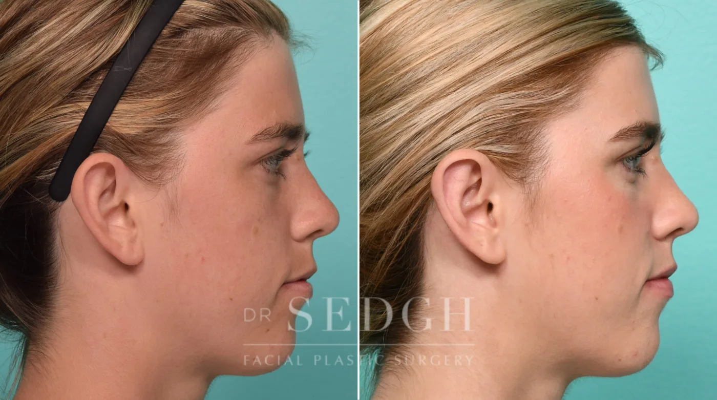 Patient 314 after Ear Pinning Surgery, view 2