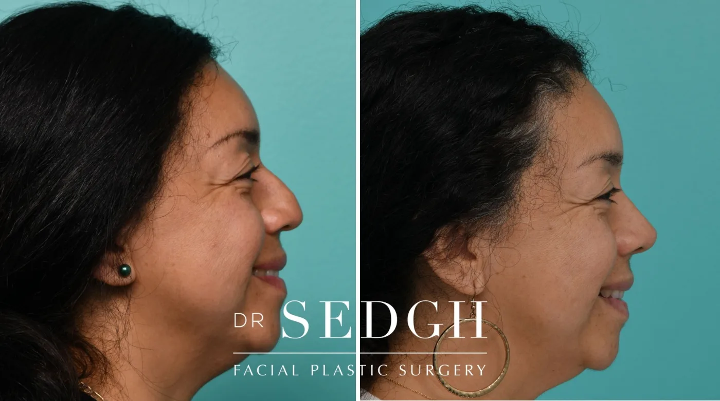 Patient 334 before Female Rhinoplasty, view 1