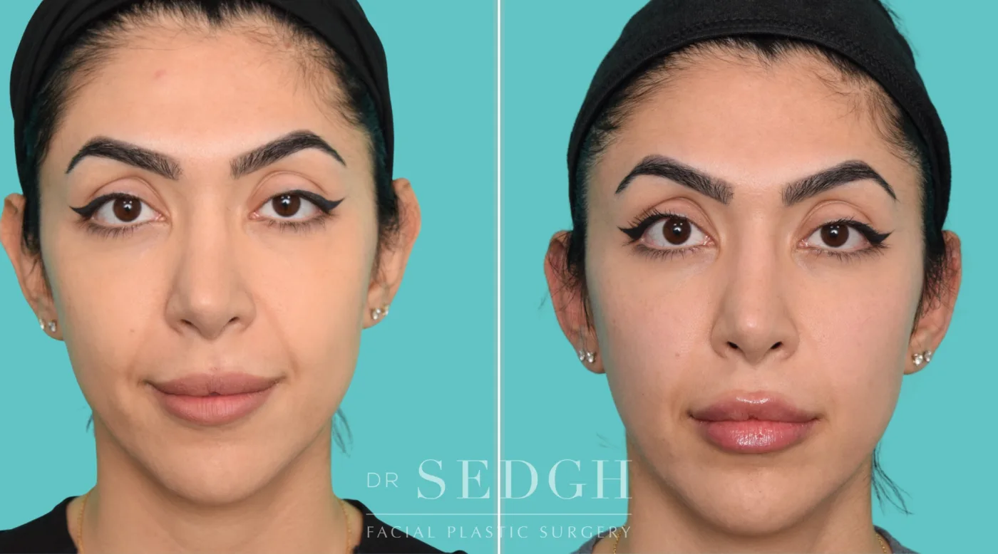 Patient 362 after Flat Helix Repair / Helical Reduction Otoplasty, view 3