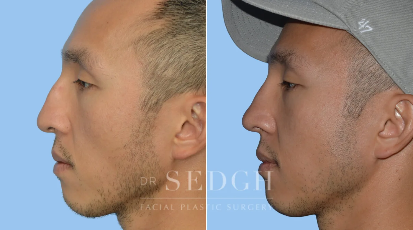 Patient 68 after Asian Rhinoplasty, view 2