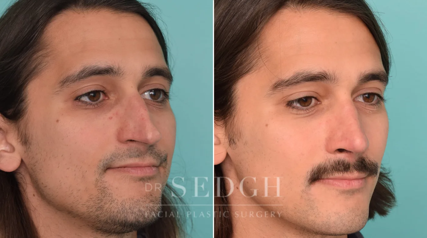 Patient 224 before Rhinoplasty, view 2