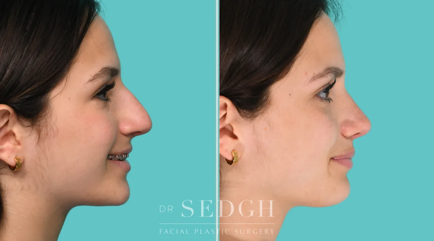Patient 350 after Middle Eastern Rhinoplasty, view 3