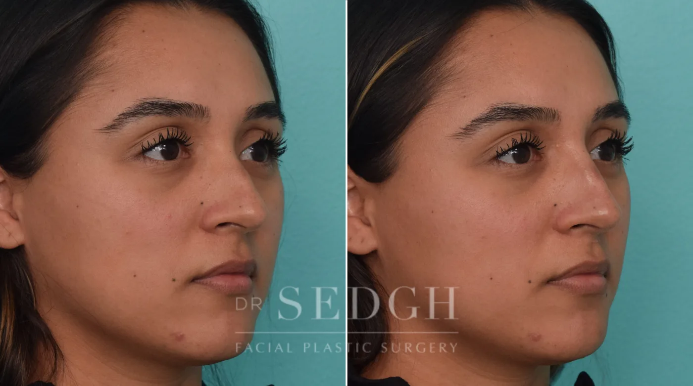 Patient 217 before Liquid Rhinoplasty, view 1