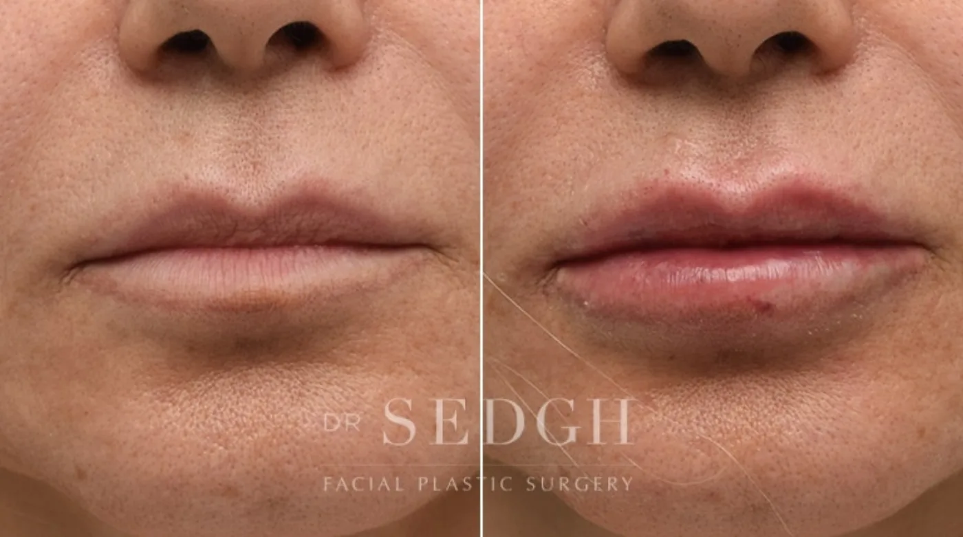 Patient 3 after lip augmentation, view 1