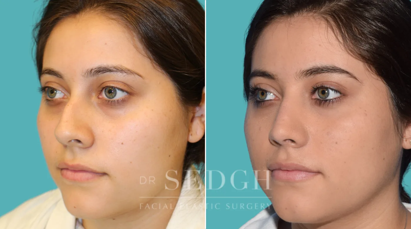 Patient 27 before Rhinoplasty, view 1