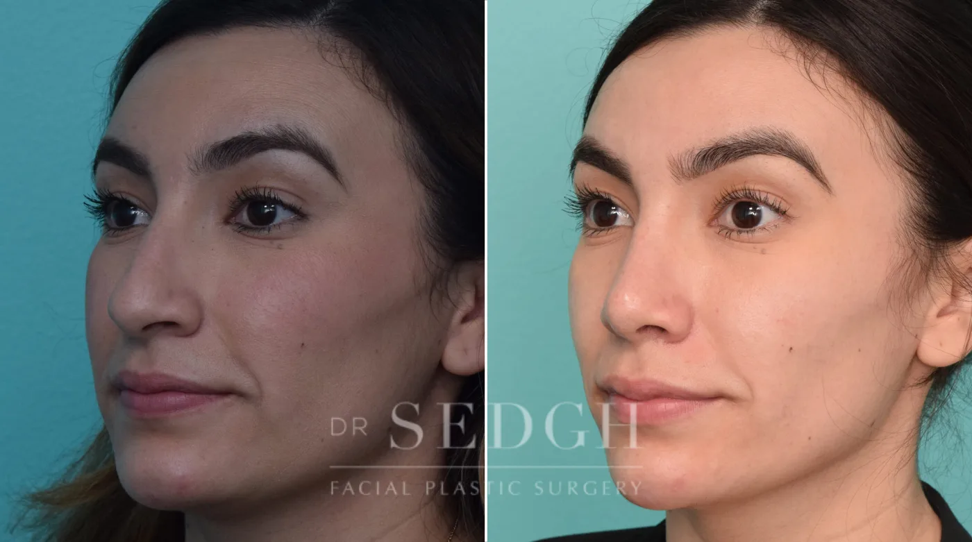 Patient 227 before Hispanic Rhinoplasty, view 2