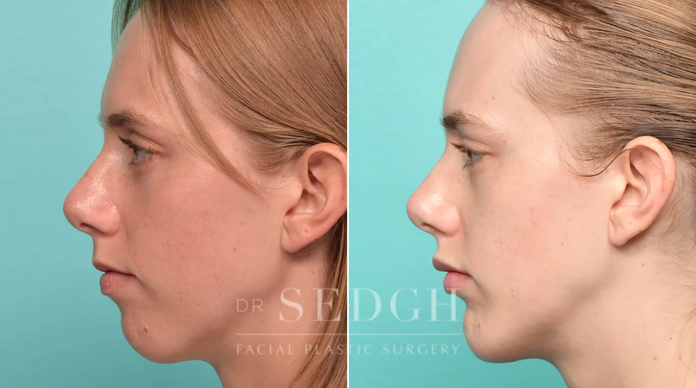 Patient 311 after Chin Augmentation, view 1