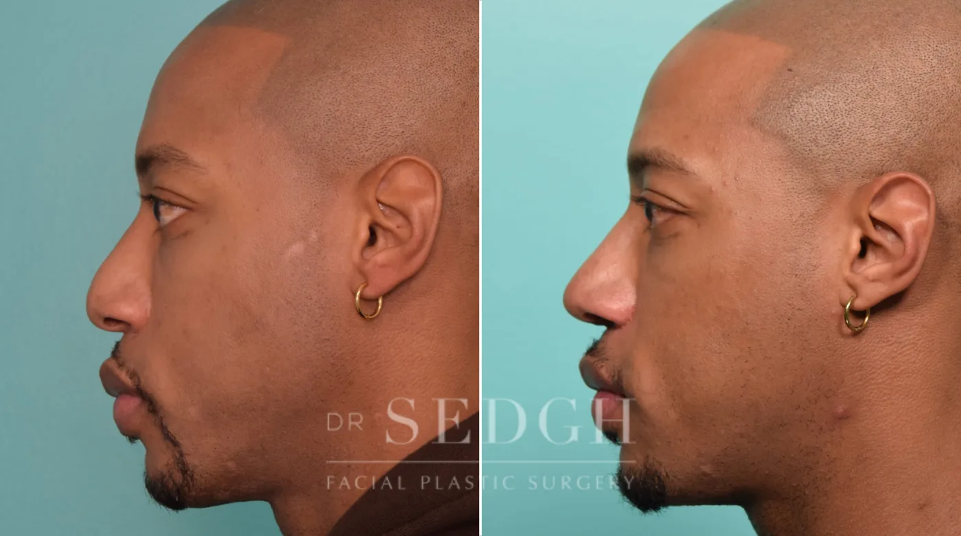 Patient 22 after Male Rhinoplasty, view 1