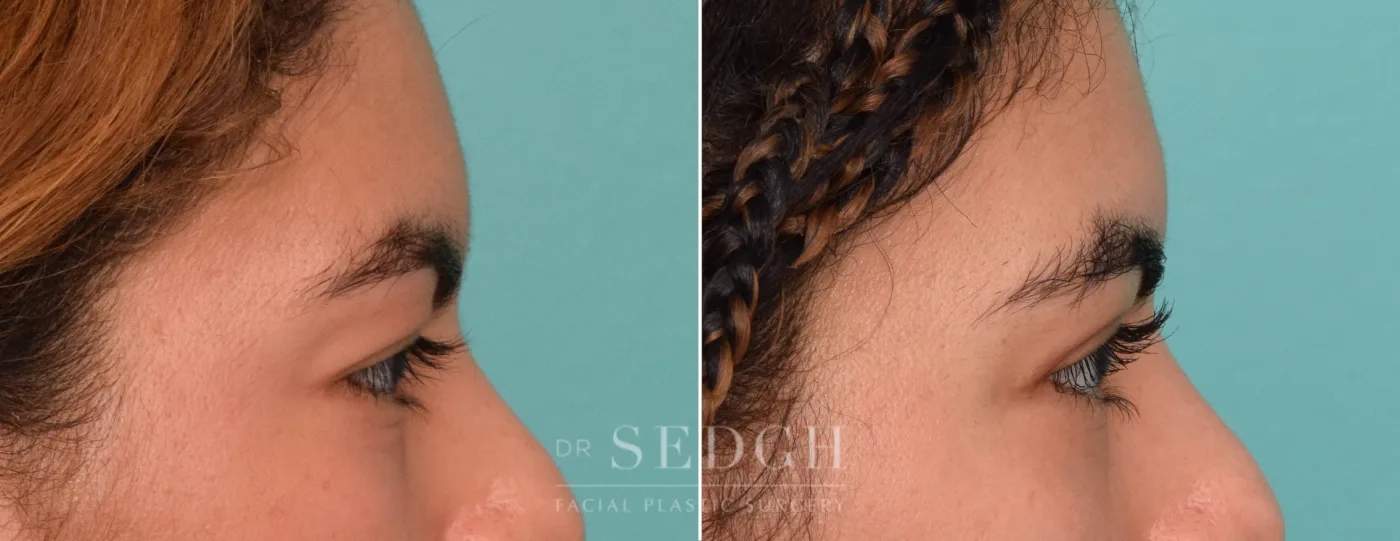Patient 300 after Upper Blepharoplasty, view 1