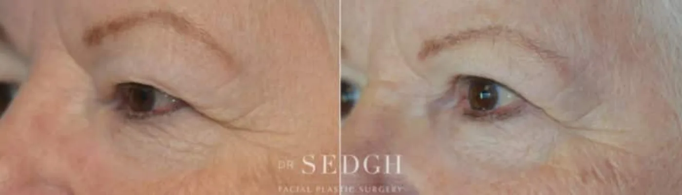 Patient 4 after Upper Blepharoplasty, view 1