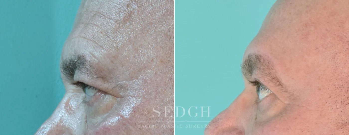 Patient 205 after Upper Blepharoplasty, view 2