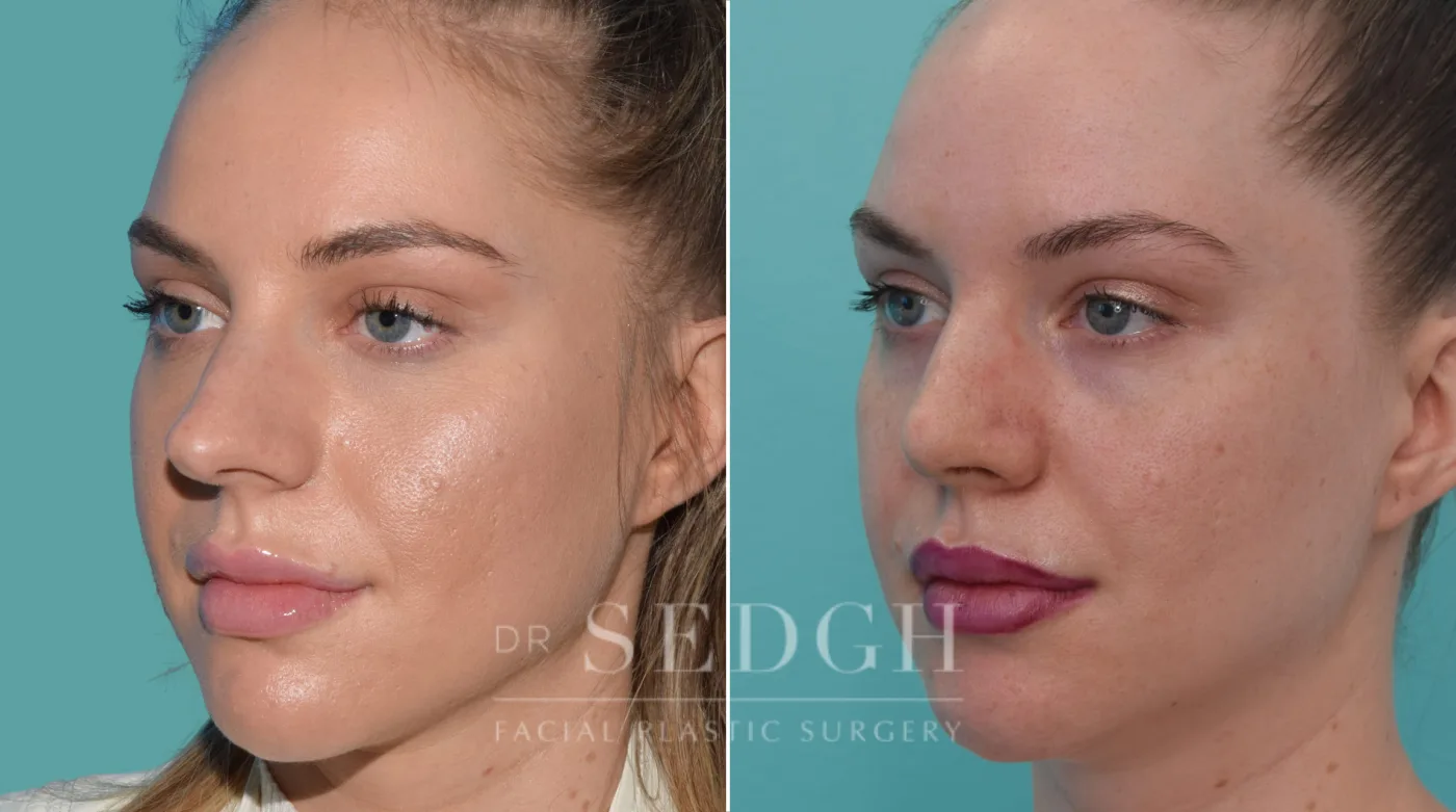 Patient 187 before Crooked Nose Surgery, view 1