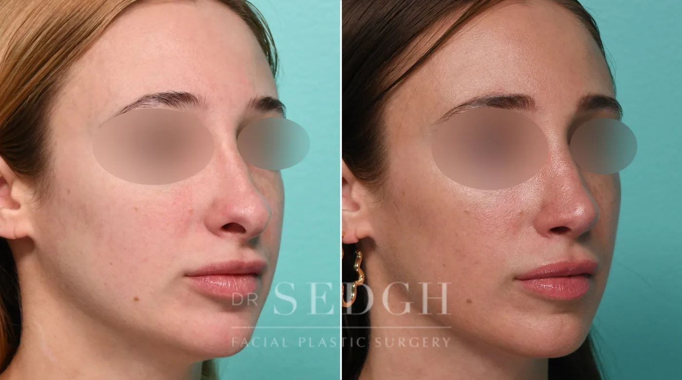 Patient 329 before Revision Rhinoplasty, view 1