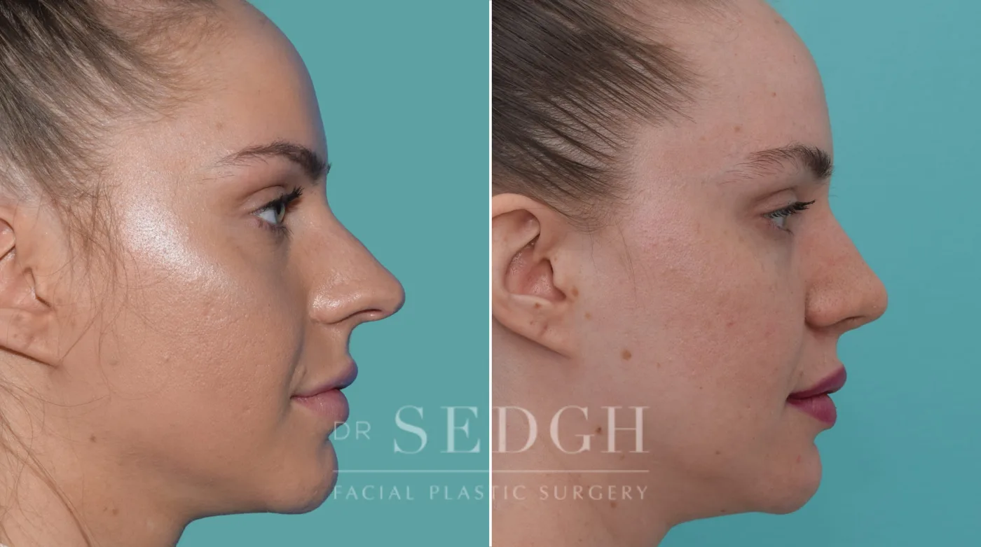 Patient 187 after Crooked Nose Surgery, view 2