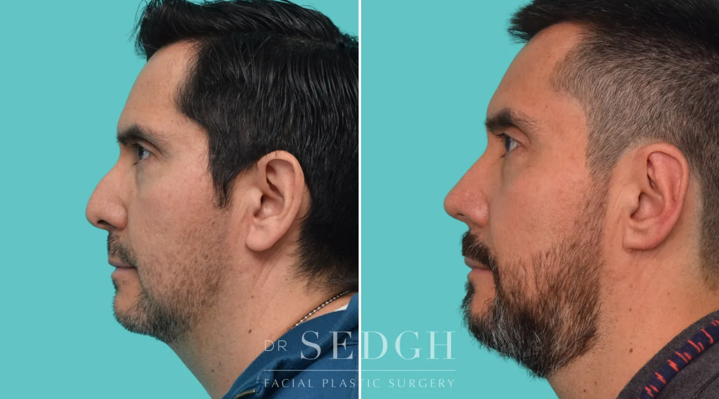 Patient 355 after Hispanic Rhinoplasty, view 3