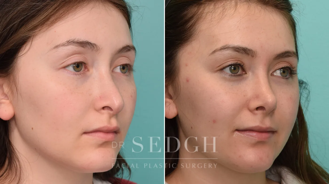Patient 328 before Revision Rhinoplasty, view 1