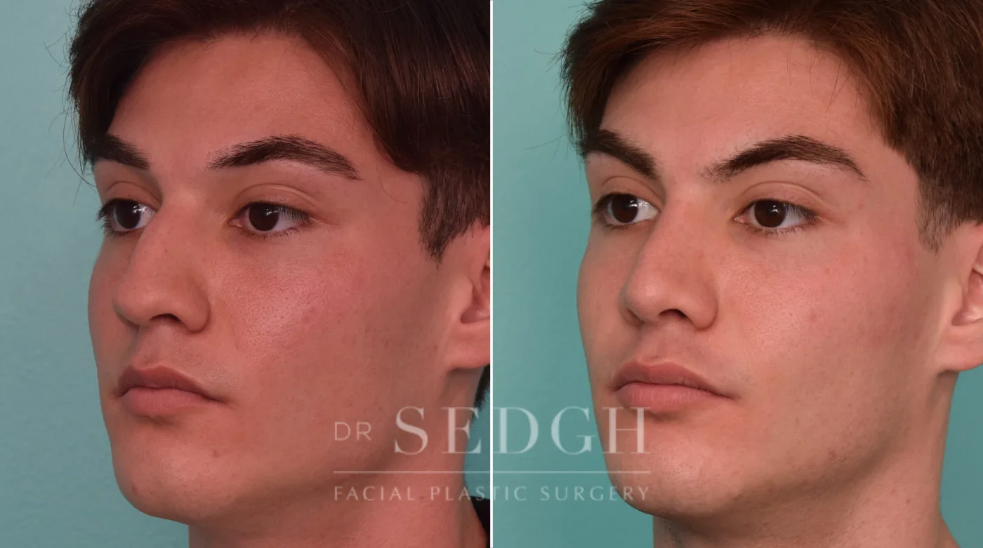 Patient 286 before Male Rhinoplasty, view 2