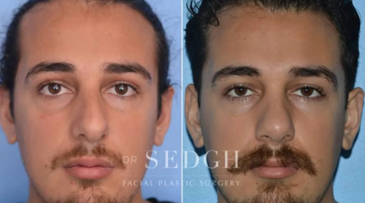 Patient 5 before Hispanic Rhinoplasty, view 1