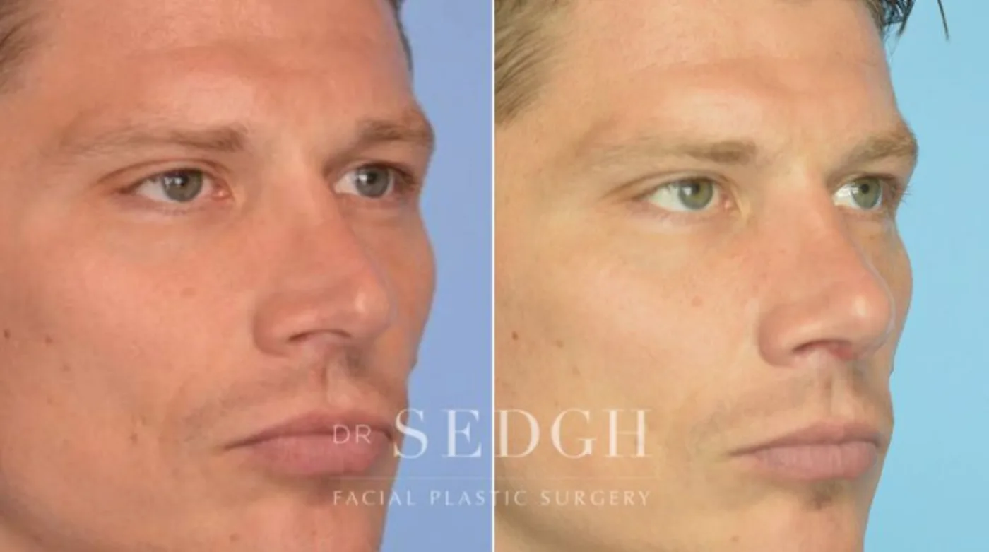 Patient 2 after Crooked Nose Surgery, view 1