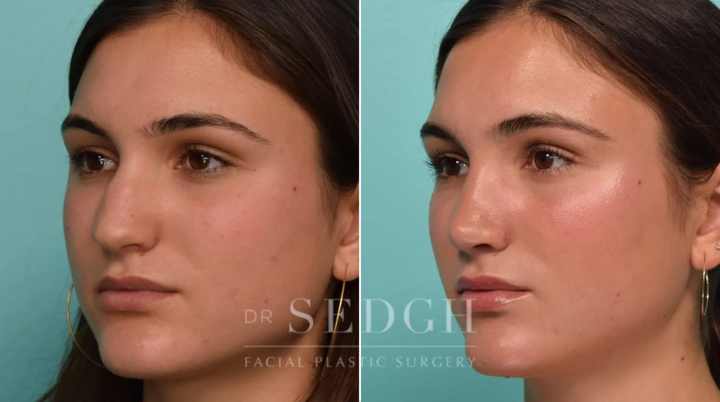 Patient 308 before Rhinoplasty, view 1