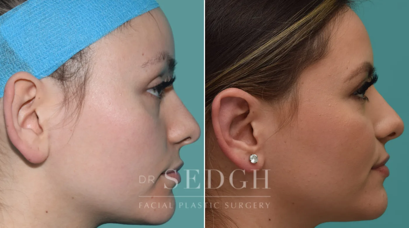 Patient 136 after Ear Pinning Surgery, view 2