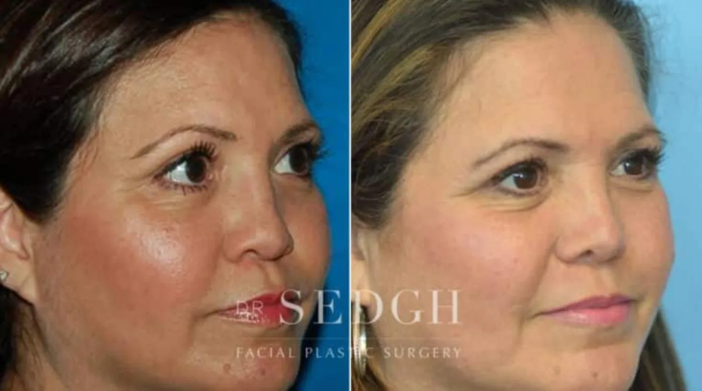 Patient 9 after Hispanic Rhinoplasty, view 1