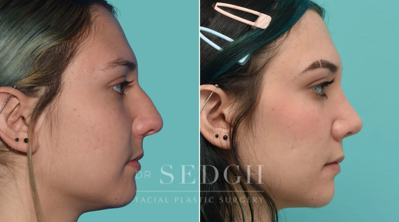 Patient 32 after Rhinoplasty, view 1