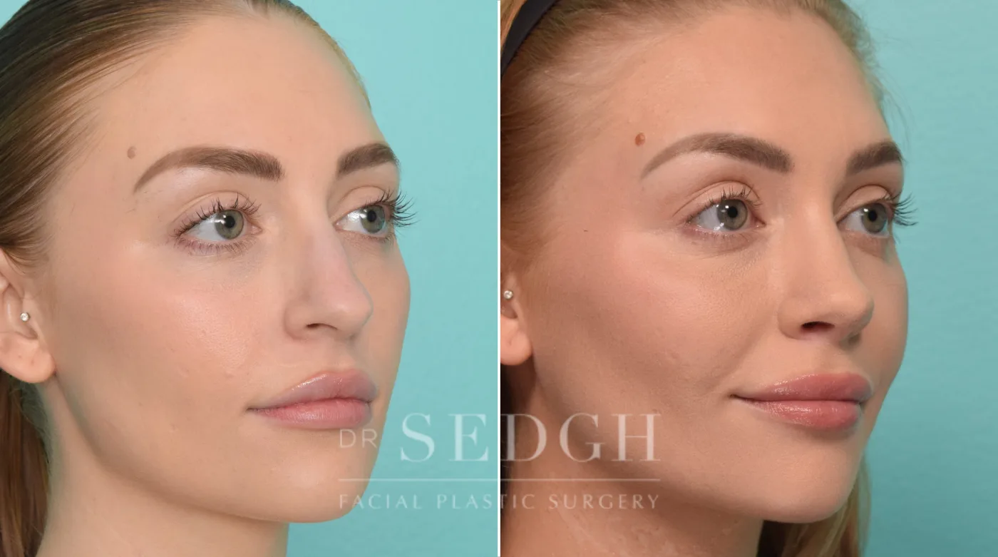 Patient 298 before Rhinoplasty, view 1
