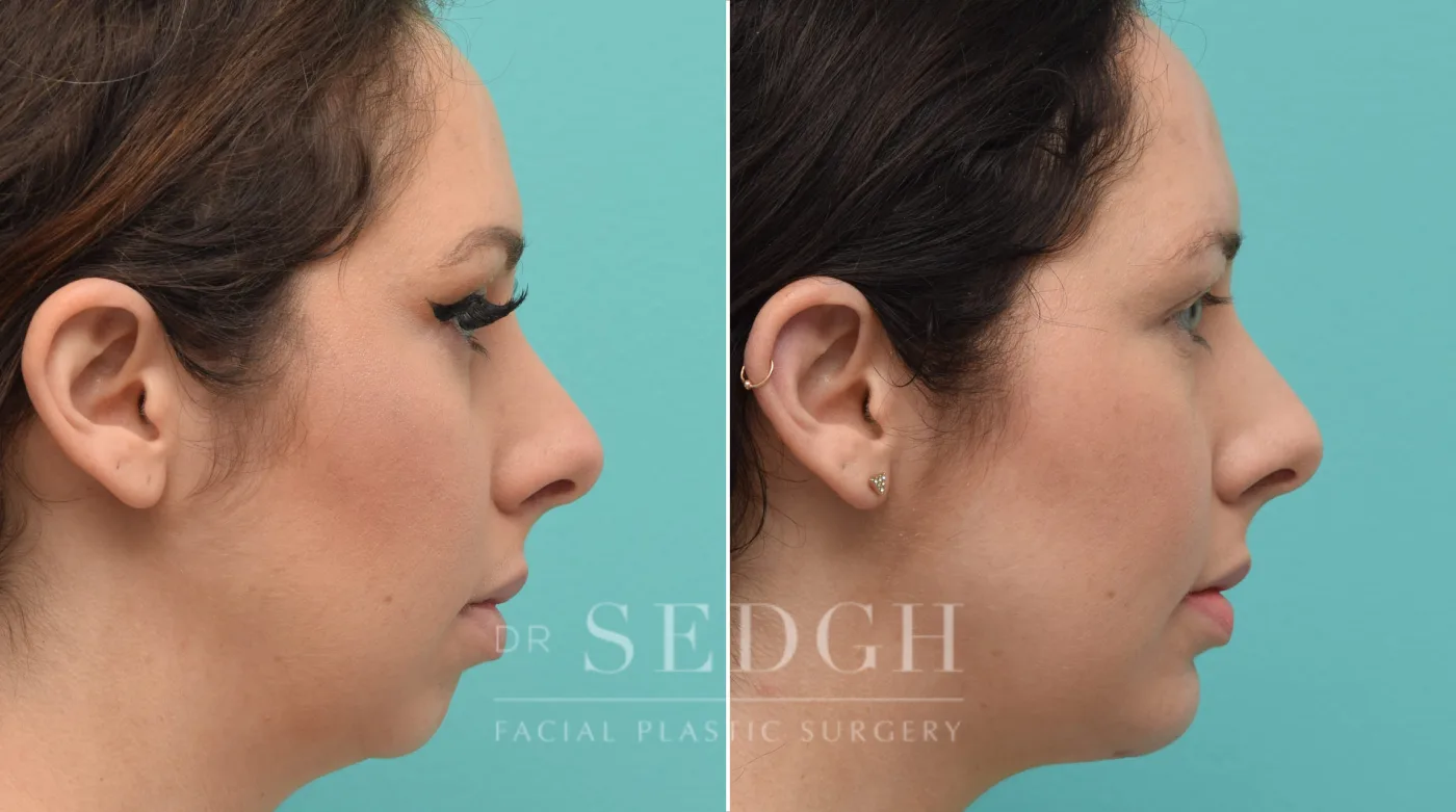 Patient 145 after Chin Augmentation, view 1