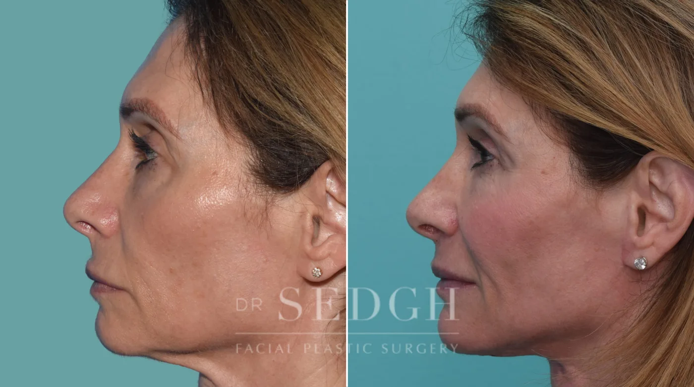 Patient 211 after Face Lift, view 1