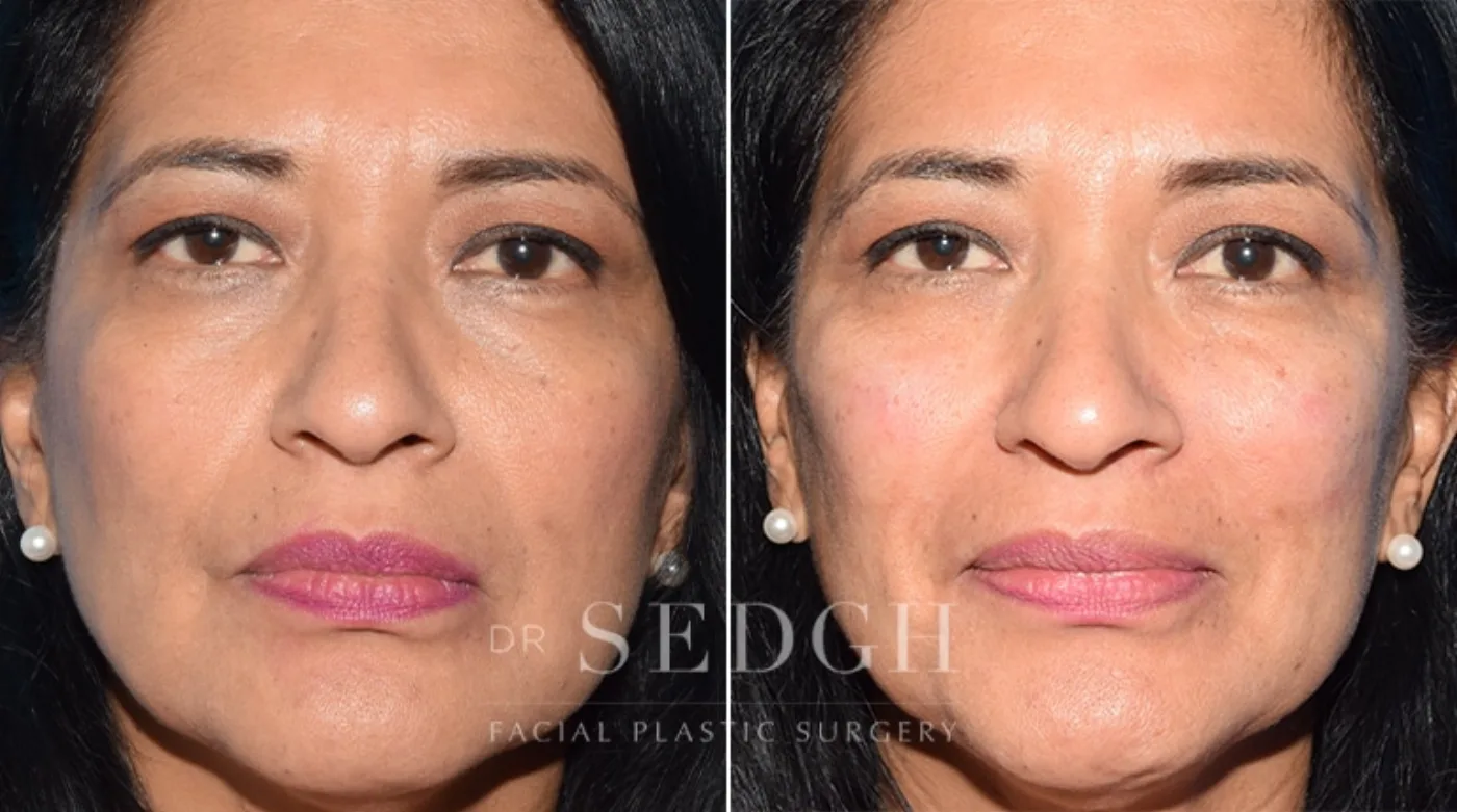 Patient 12 before Facial Fillers, view 1