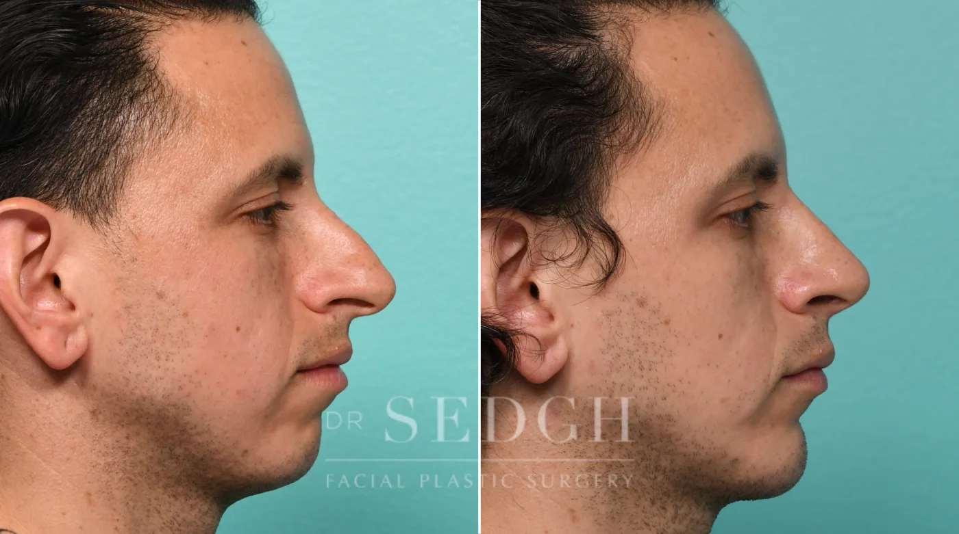 Patient 323 after Chin Augmentation, view 1