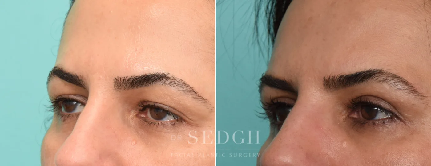 Patient 252 before Upper Blepharoplasty, view 1
