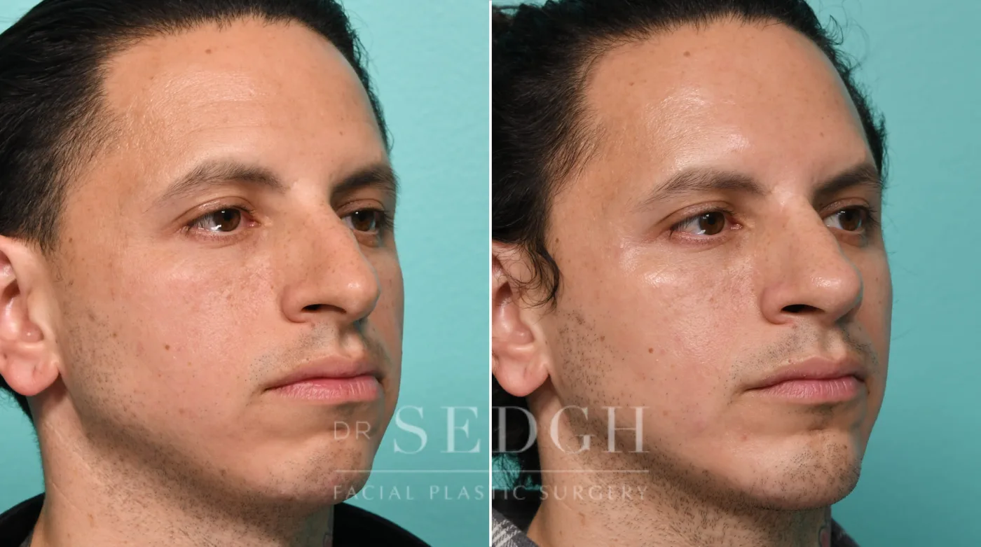 Patient 323 before Chin Augmentation, view 1