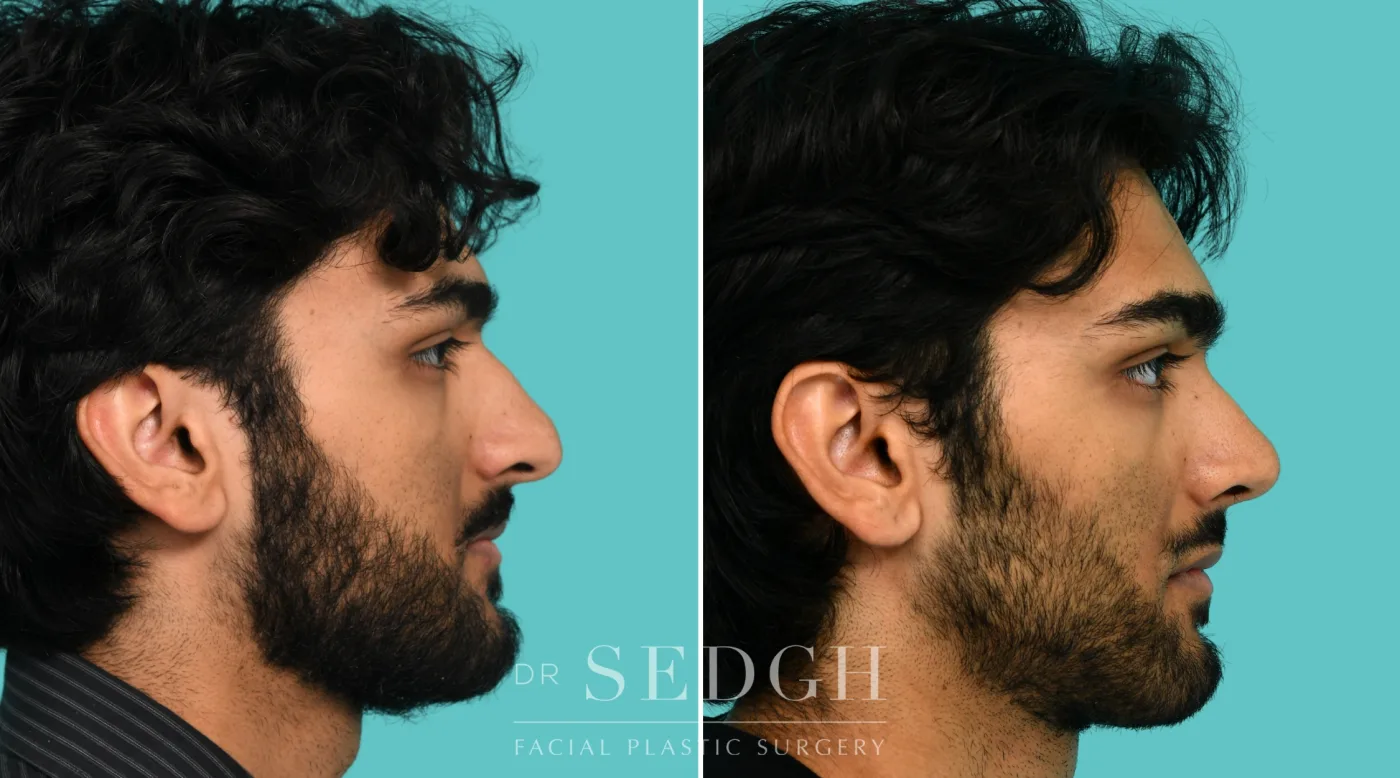 Patient 364 before Male Rhinoplasty, view 2