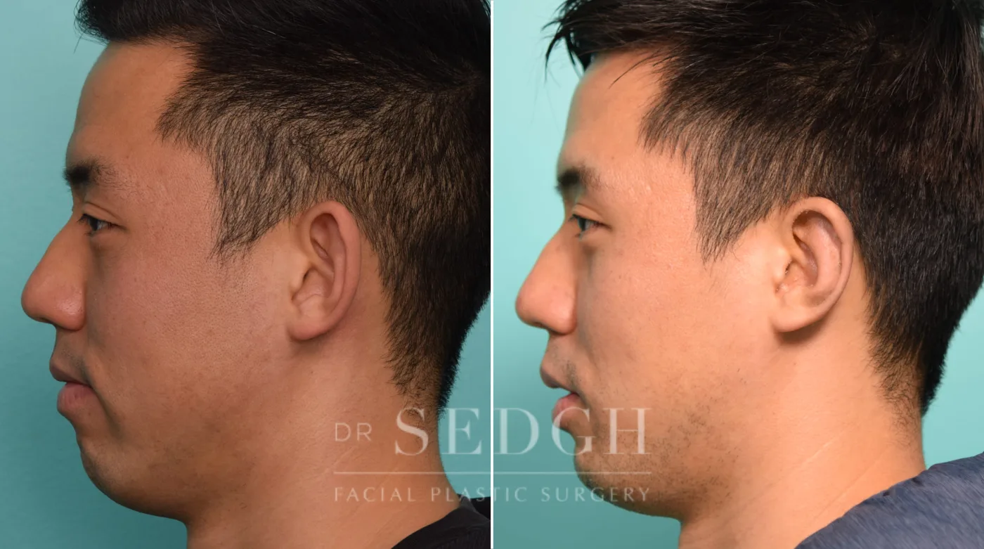 Patient 265 after Ear Pinning Surgery, view 1