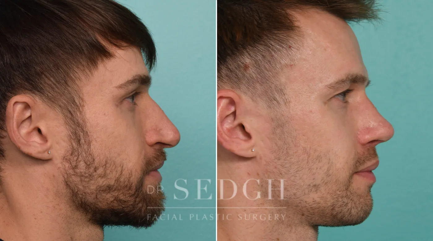 Patient 330 after Revision Rhinoplasty, view 1