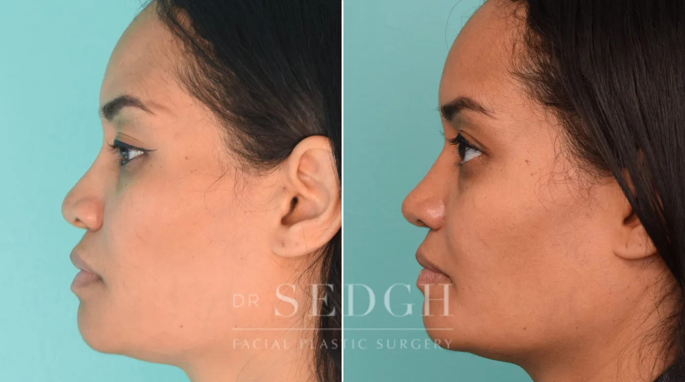 Patient 229 after Female Rhinoplasty, view 1