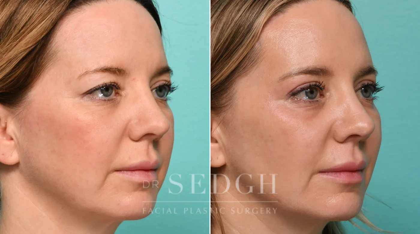Patient 322 before Brow Lift, view 1