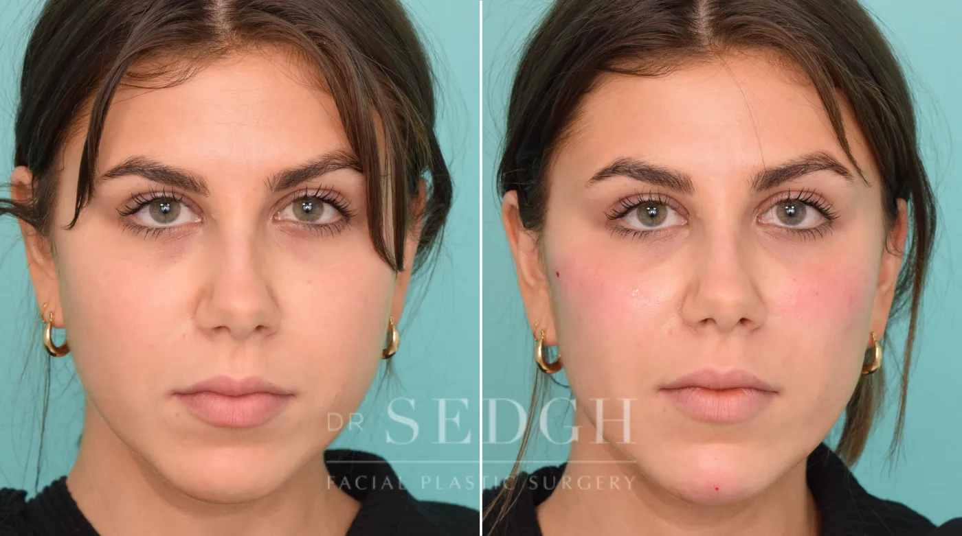 Patient 233 after Chin Filler, view 1