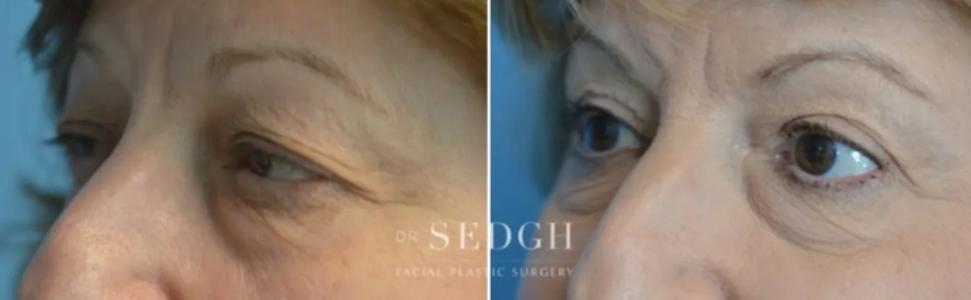 Patient 9 after Upper Blepharoplasty, view 1