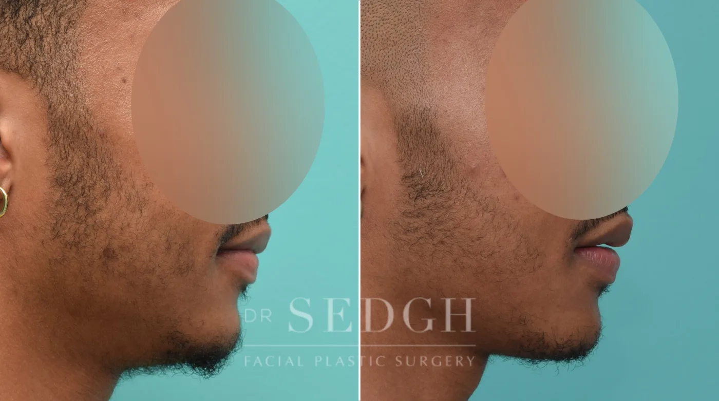 Patient 148 after Chin Augmentation, view 1