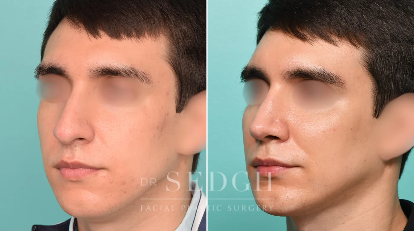 Patient 317 before Neck Liposuction, view 2