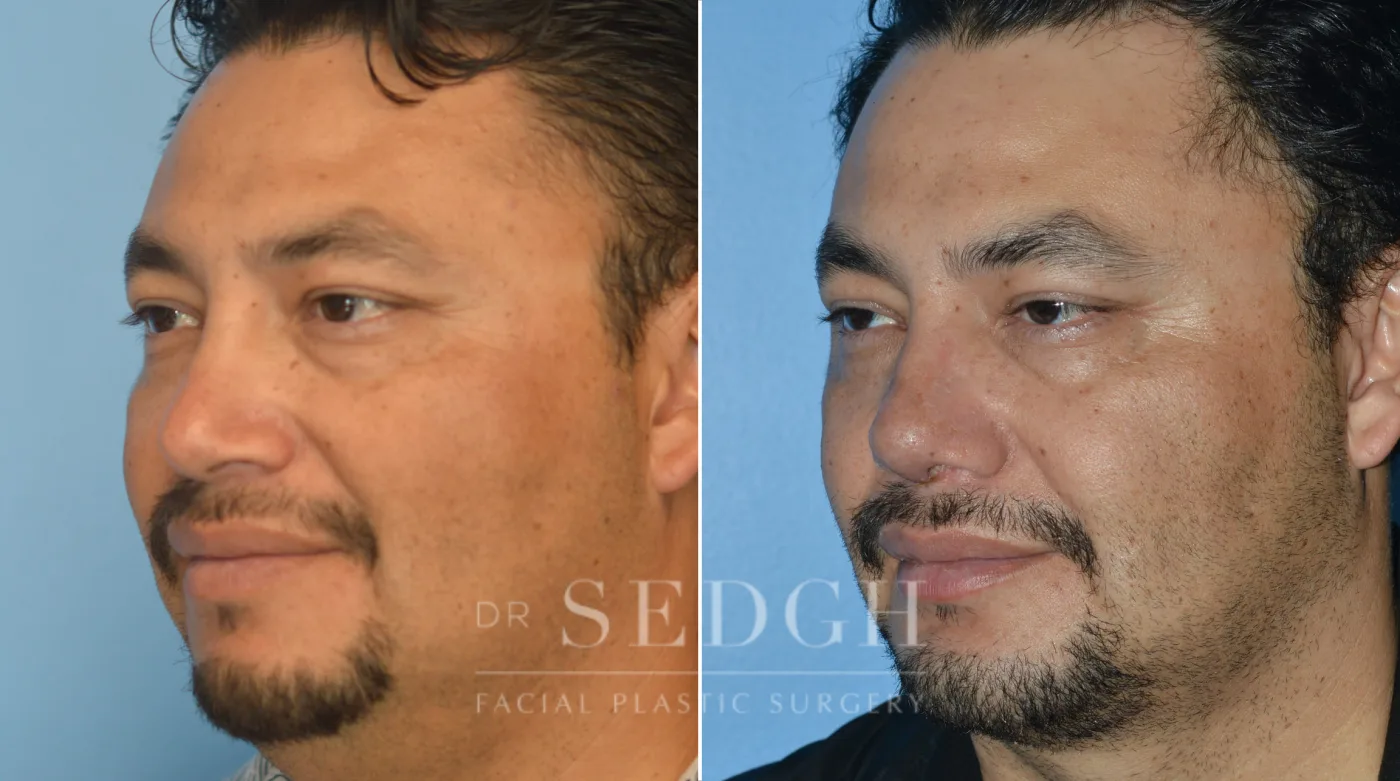 Patient 80 before Chin Augmentation, view 2