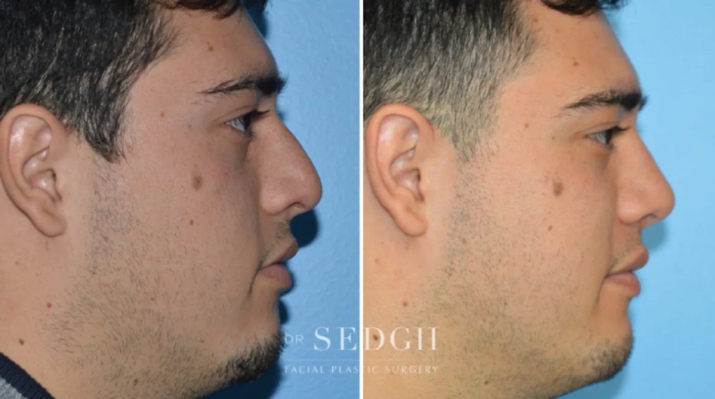 Patient 7 after Crooked Nose Surgery, view 2