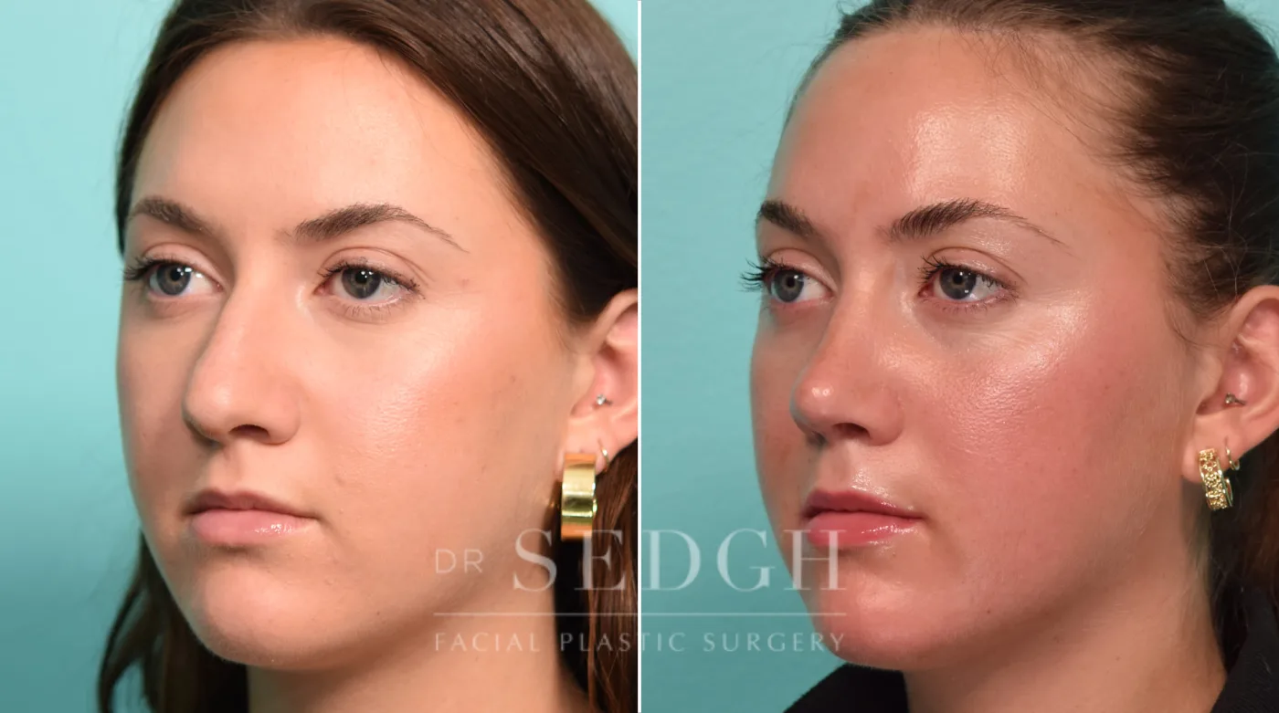 Patient 297 before Rhinoplasty, view 2