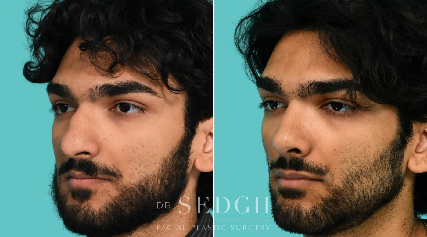 Patient 364 before Male Rhinoplasty, view 1