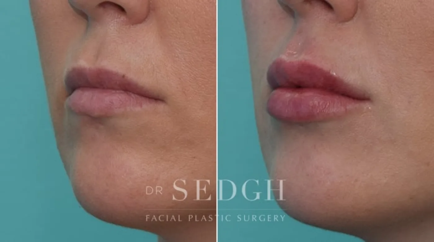 Patient 6 before lip augmentation, view 1